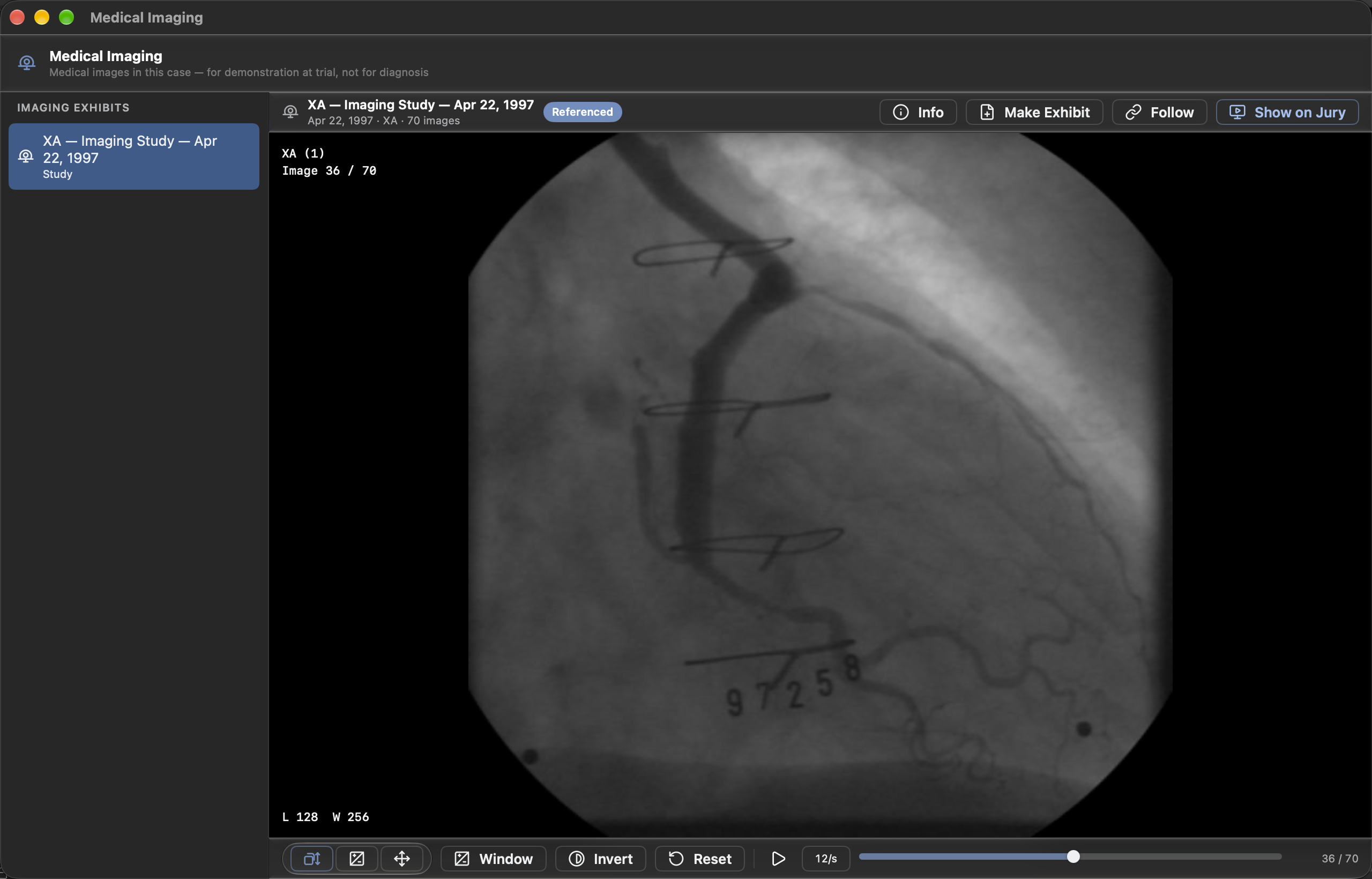 The Medical Imaging window: an angiography study listed on the left and the image on black, with Window, Invert, Reset, and cine playback below it.